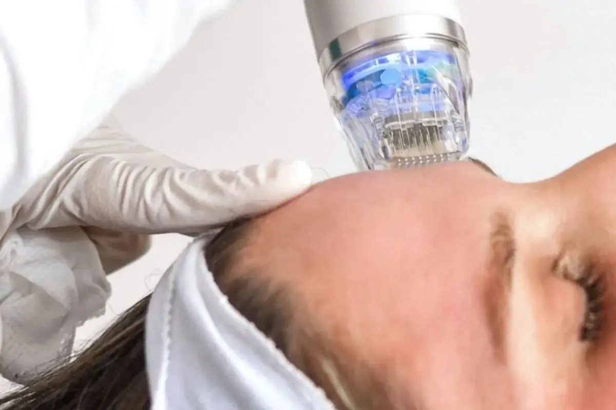 Radiofrecuencia fraccionada facial en Centro EBM Castelldefels